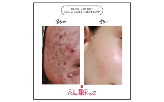 SheRose Face Cream